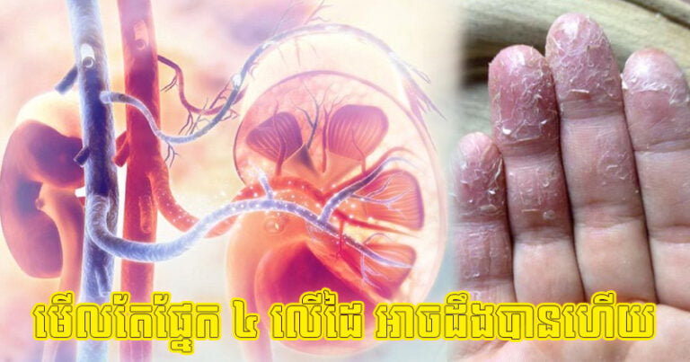 ចង់​ដឹង​បុរស​នោះ​មាន​តម្រង​នោម​ល្អ​អត់ សម្លឹង​មើល​តែ​ផ្នែក ៤ ​លើ​ដៃ អាច​ដឹង​បាន​ហើយ