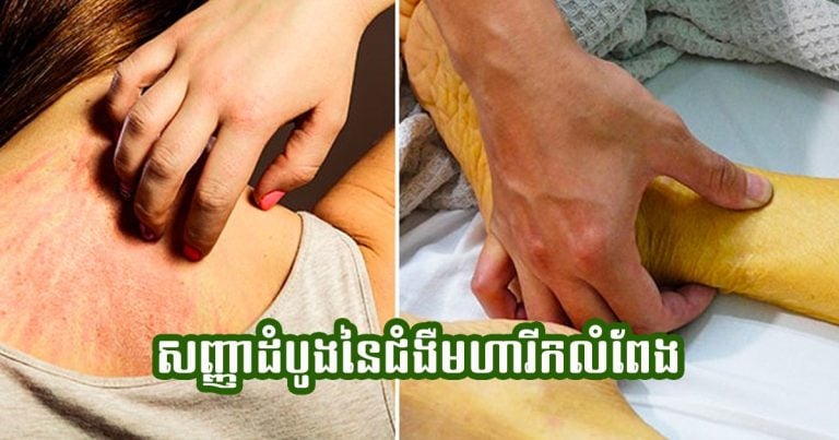 សញ្ញាព្រមានដំបូងទាំង ៥ នៃជំងឺមហារីកលំពែង ដែលអ្នកមិនត្រូវព្រងើយកន្តើយឡើយ!!!